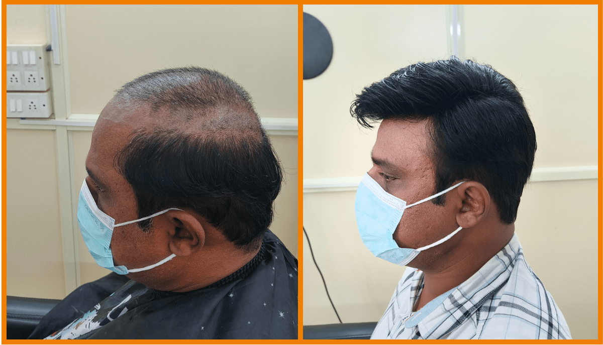 Natural looking hair patch