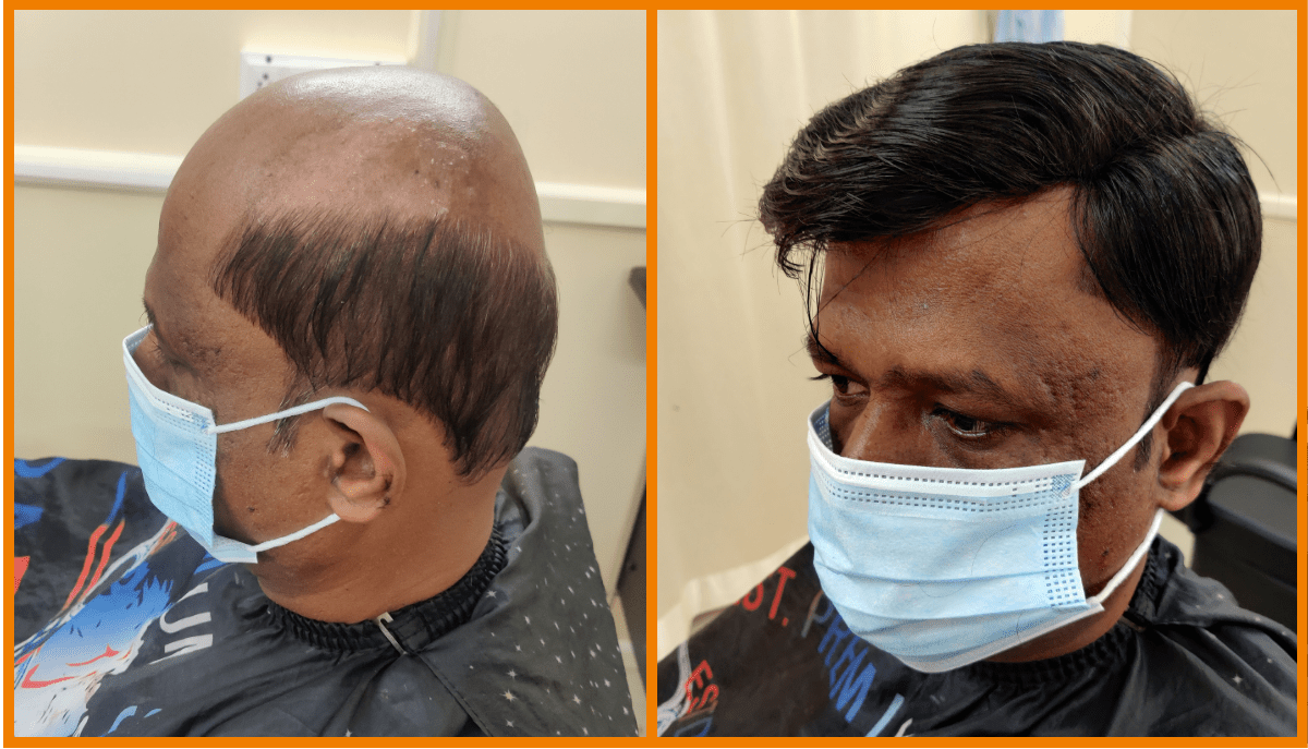Hair loss solution for men
